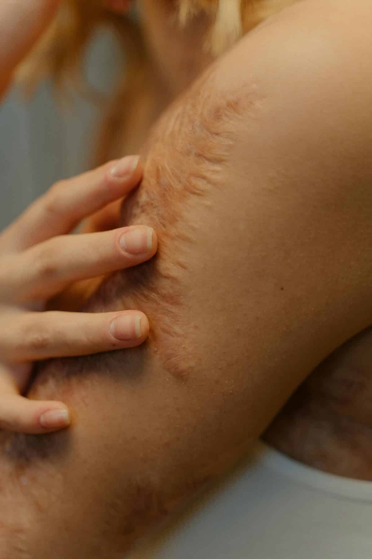 Kaltplasmabehandlung wird u. a. bei Narben, Mykosen und tiefen Hautrissen eingesetzt.